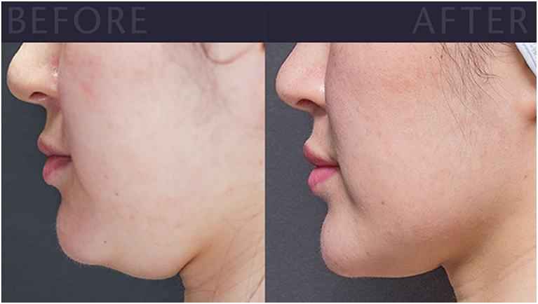 Double chin correction