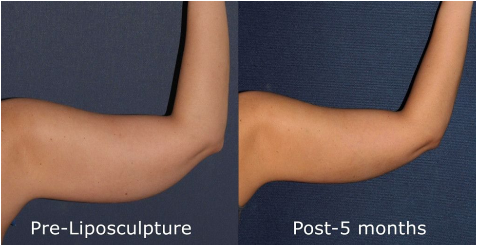 Arm contouring