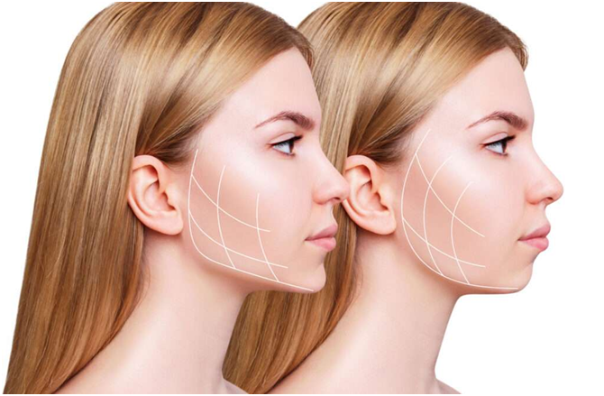 Buccal fat pad removal