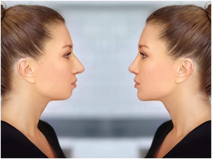 Chin augmentation