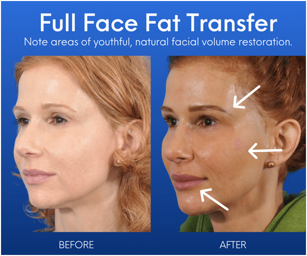 Facial Fat Grafting