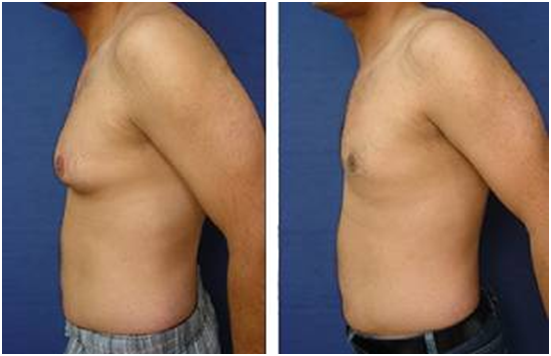 Gynaecomastia correction