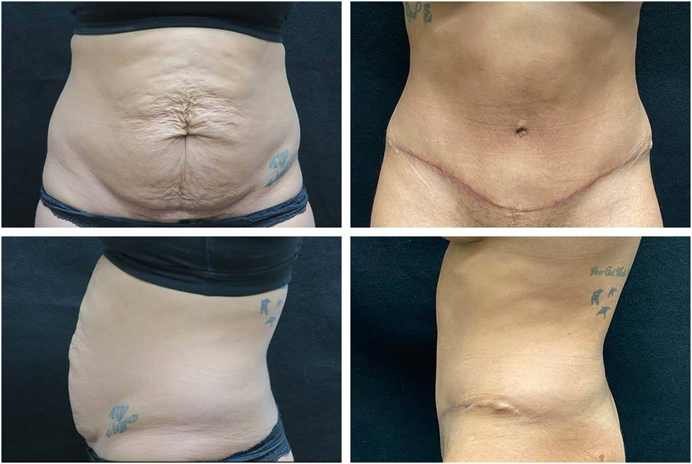 Tummy tuck